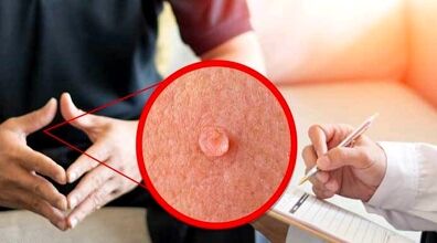 چند مدت بعد از درمان زگیل تناسلی می توان رابطه جنسی داشت؟ | متاهلین حتما بخوانند