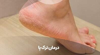 برای درمان خشکی و ترک پا، این ترکیب خونگی معجزه می کنه! + فیلم