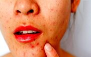 با جوش بعد از خوردن آجیل چیکار کنیم؟ | درمان فوری جوش به روش خانگی