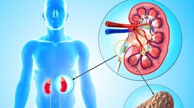 قاتل سنگ کلیه را بشناسید + توضیحات
