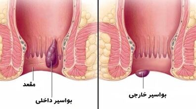 بواسیر یا هموروئید رو با این روش ها درمان کن! | راهکارهای خانگی برای درمان بواسیر