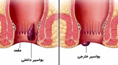 بواسیر یا هموروئید رو با این روش ها درمان کن! | راهکارهای خانگی برای درمان بواسیر