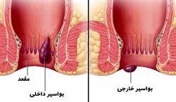 بواسیر یا هموروئید رو با این روش ها درمان کن! | راهکارهای خانگی برای درمان بواسیر