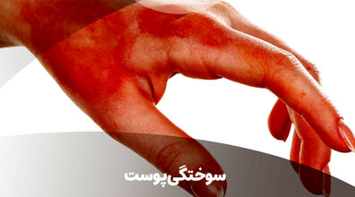 اگه سوختگی رو اینجوری درمان کنی دیگه جاش نمیمونه!