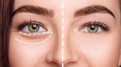 اول صبح چشام پف می کنه، چیکار کنم؟ | علت و ترفندهای خانگی رفع پف چشم
