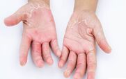 چرا دستم پوست پوست میشه؟ + روش درمان 