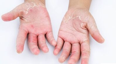 چرا دستم پوست پوست میشه؟ + روش درمان 